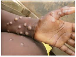 Guard Against Monkeypox: How to Stay Informed and Prepared
